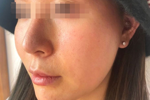 陈女士面部黄褐斑皮肤松弛