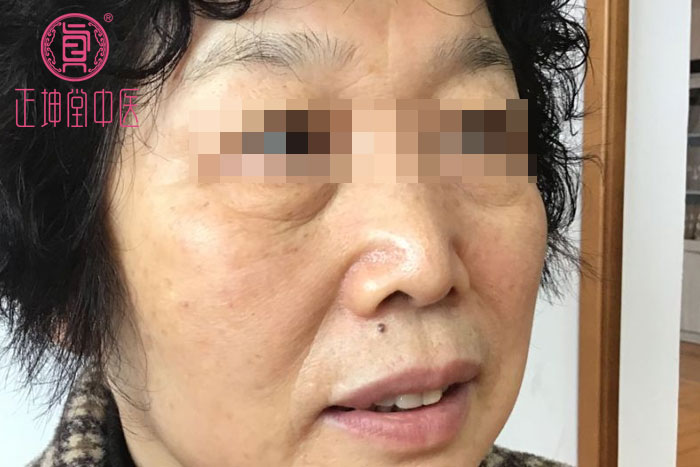 脸部衰老特别快怎么办