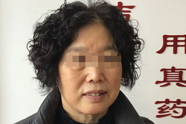 张女士面部皮肤暗黄松弛