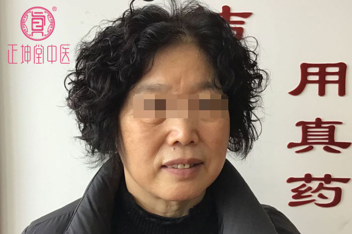 脸部衰老特别快怎么办