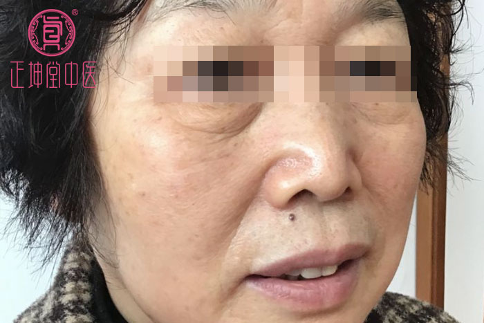 脸部衰老特别快怎么办