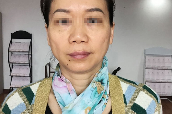 赵女士更年期衰老案例