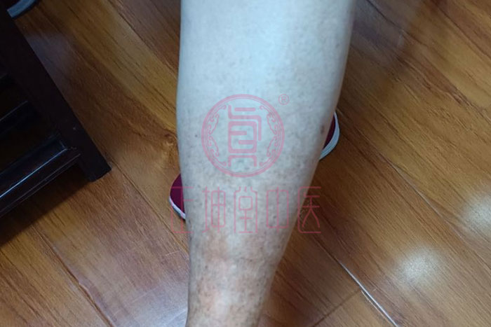 膝关节疼痛如何治愈