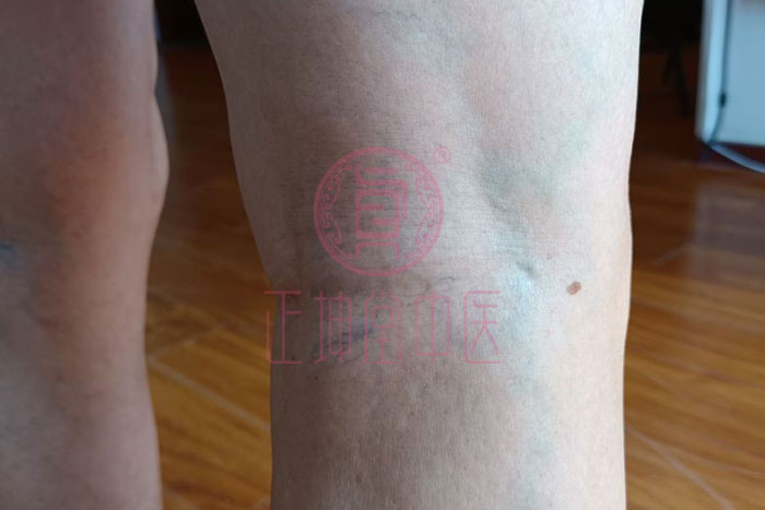 膝关节疼痛如何治愈