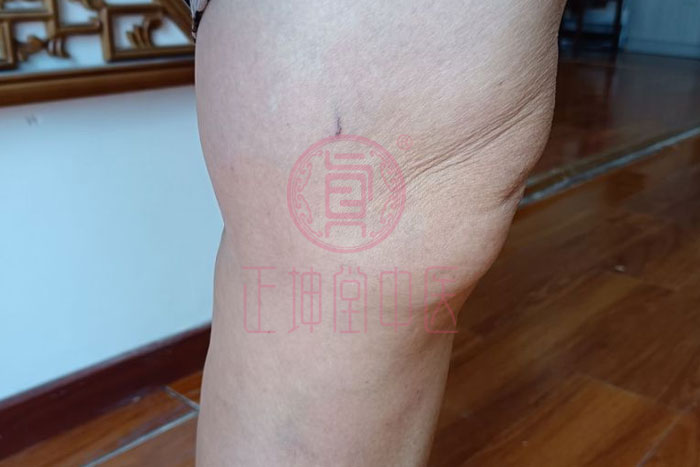 膝关节疼痛如何治愈