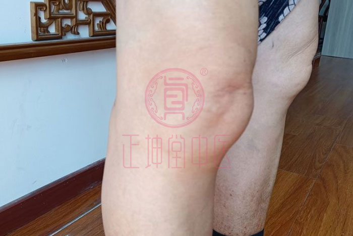 膝关节疼痛如何治愈