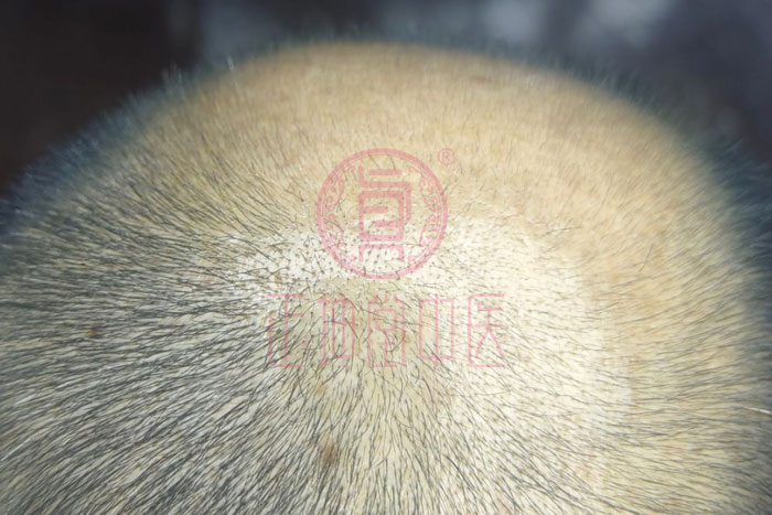如何解决脱发好