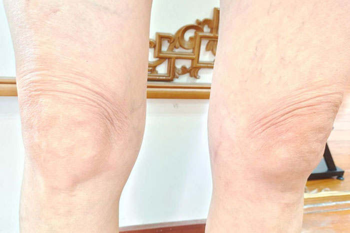 王女士膝关节疼痛
