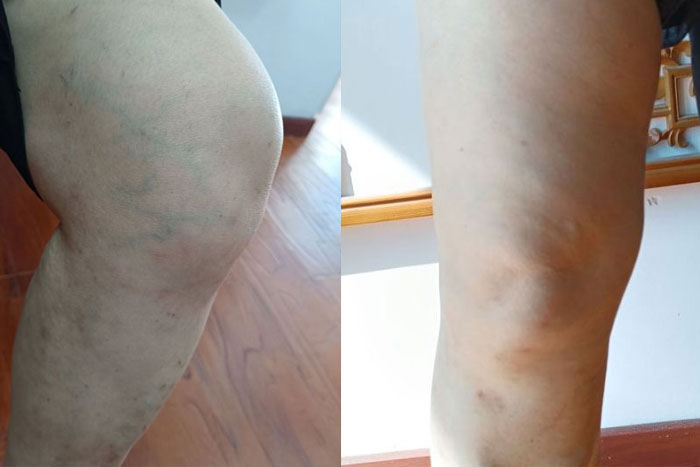戴女士膝关节炎症