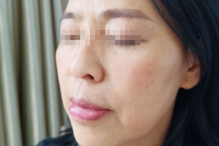 刘女士更年期皮肤老化案例