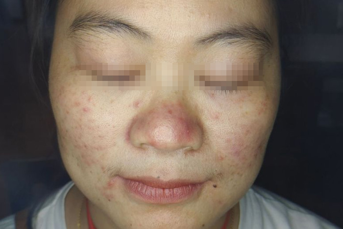 秦女士患有卵巢囊肿中医治愈案例