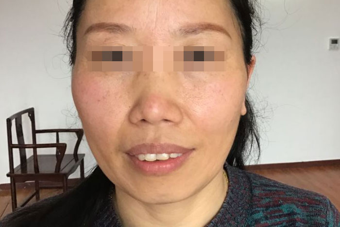 何女士更年期衰老皮肤案例