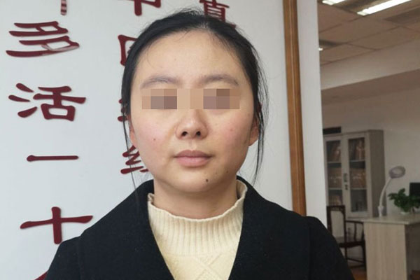 张女士产后衰老治愈案例