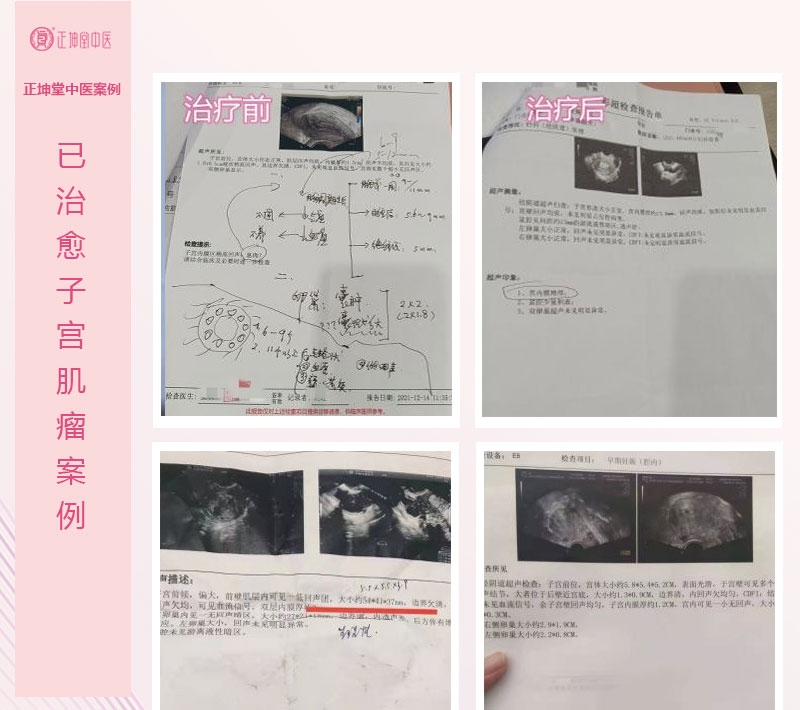 子宫肌瘤如何治疗效果好