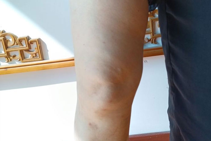 田女士膝关节疼痛治愈案例