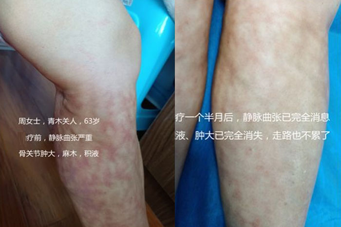 周女士膝关节肿大，麻木，积液