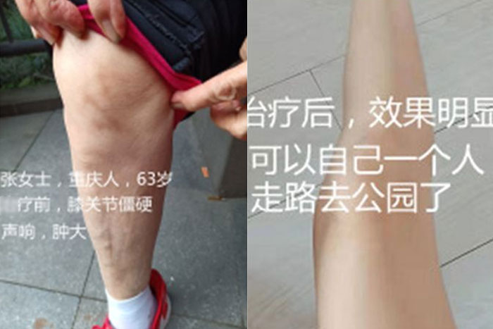 张女士膝关节僵硬