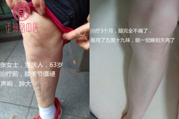 张女士膝关节僵硬