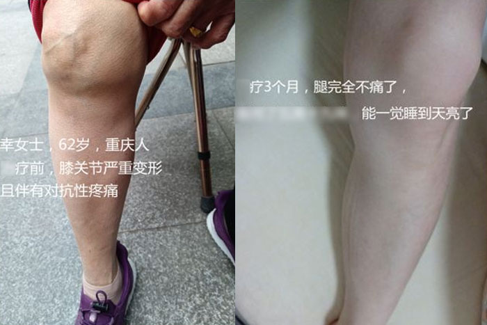 幸女士膝关节严重变形