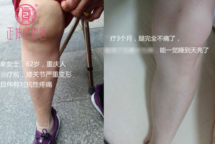 幸女士膝关节严重变形
