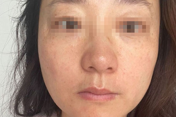 王女士产后衰老治愈案例