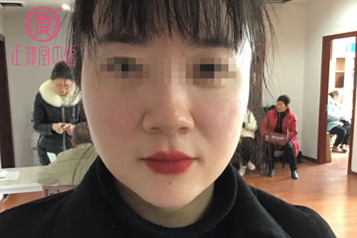 衰老期皮肤松弛