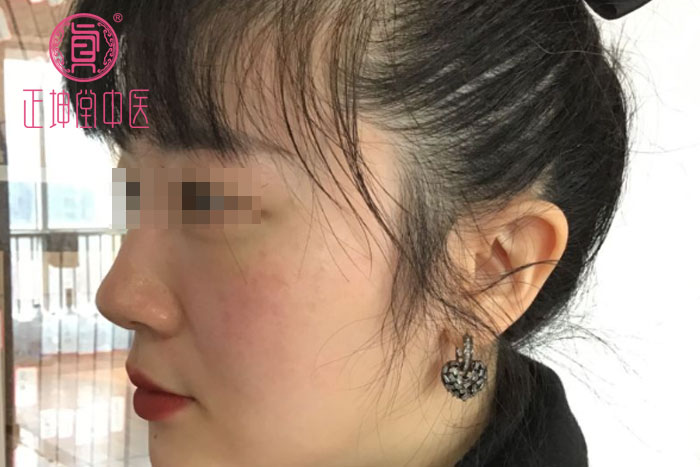 衰老期皮肤松弛