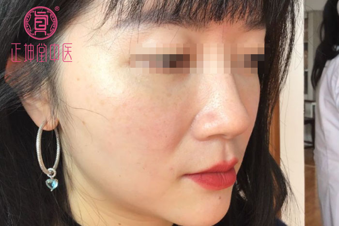衰老期皮肤松弛