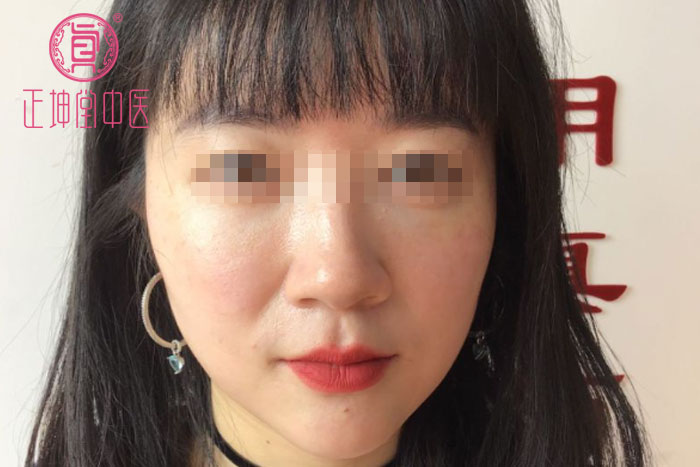 衰老期皮肤松弛