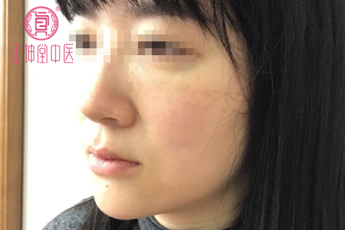 衰老期皮肤松弛