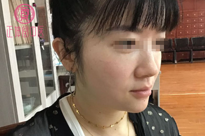 衰老期皮肤松弛
