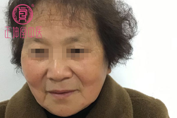 老年期衰老治愈案例