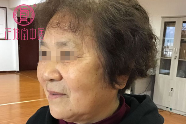 老年期衰老治愈案例