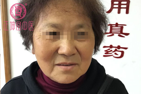 老年期衰老治愈案例