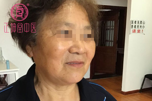老年期衰老治愈案例