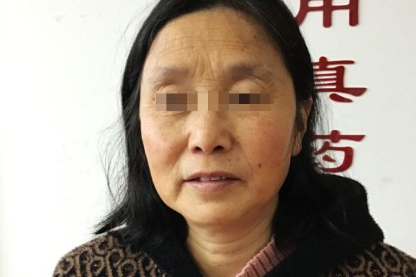 邹女士老年期衰老案例