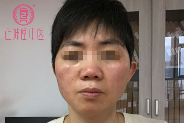 更年期衰老案例