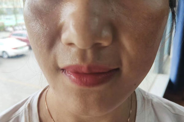 秦女生产后皮肤皱纹干燥