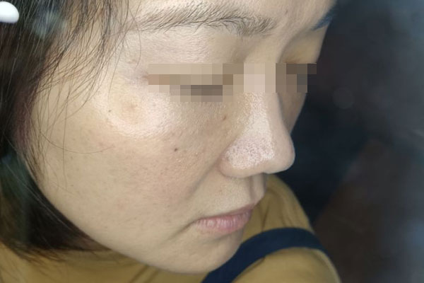 殷女生产后皮肤干燥案例