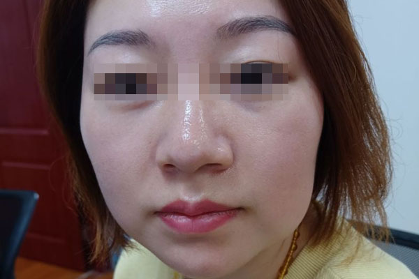 周女生产后皮肤粗糙干燥