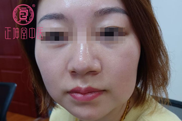 周女生产后皮肤粗糙干燥