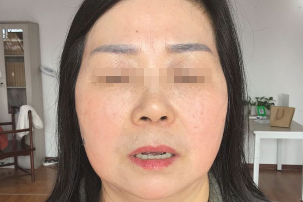 杨女生老年期衰老皮肤松弛干燥