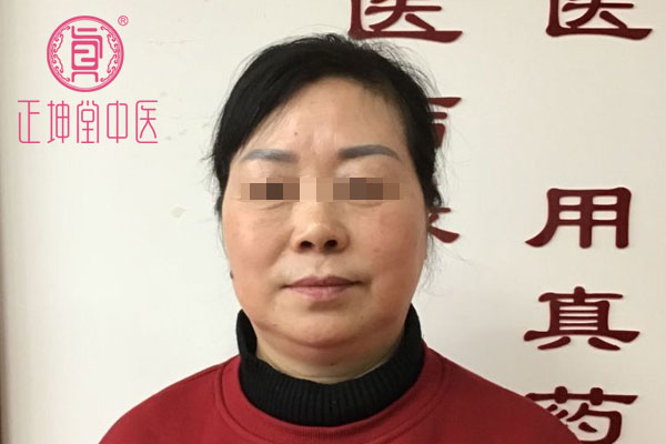 老年期衰老皮肤松弛干燥
