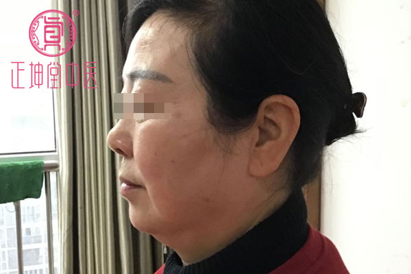 老年期衰老皮肤松弛干燥