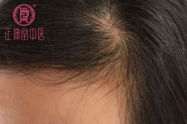 老年期衰老皮肤松弛干燥