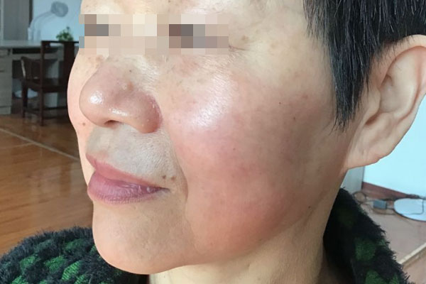 蔡女士老年期衰老皮肤干燥