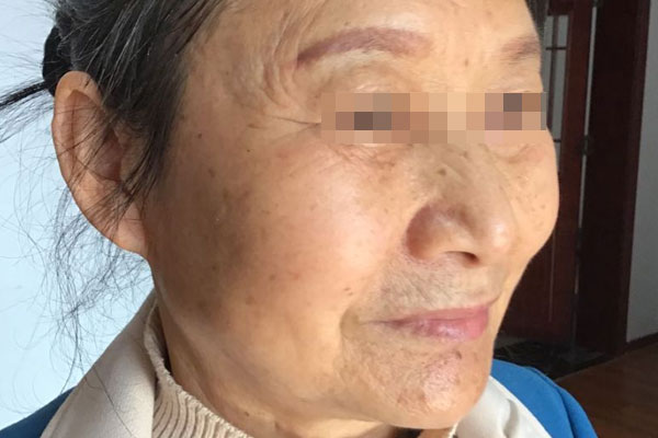 胡女士老年期衰老治愈案例