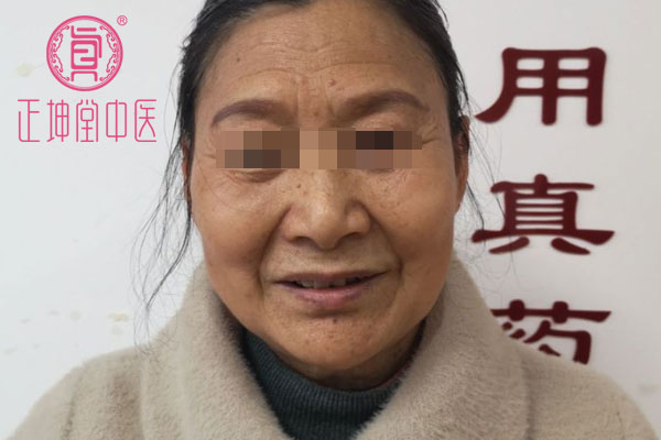 老年期衰老皮肤干燥