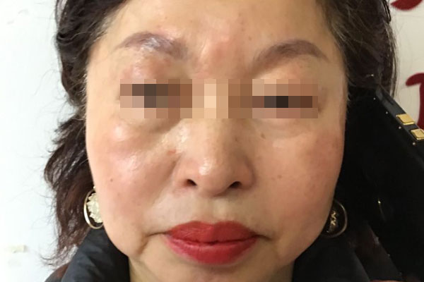 黎女士更年期衰老治愈案例