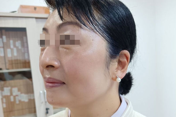 易女士更年期皮肤干燥